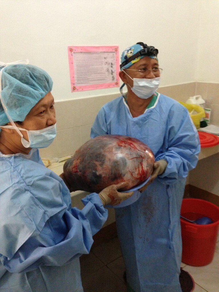 Medical Ministry Staff Volunteers remove ovarian cyst.